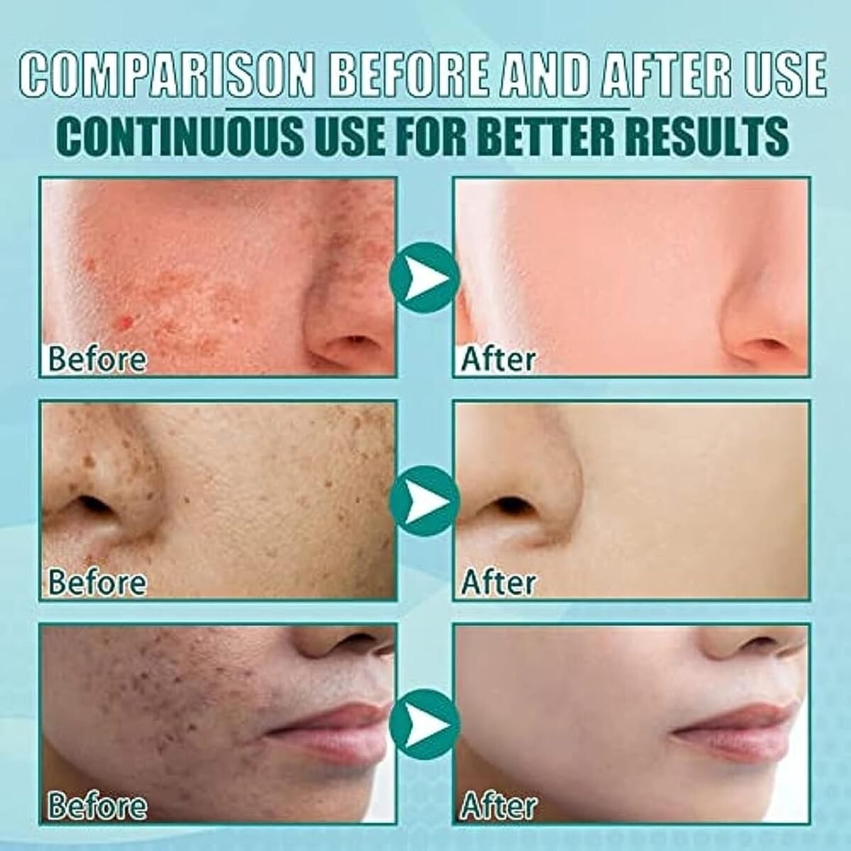 Dr. Hancy White Spot Melasma Cream - Image 7