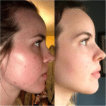 Ordinary Azelaic Acid Suspension 10% - Image 4